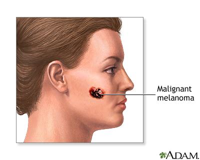 malignant melanoma medical term
